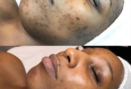 Facial Treatments